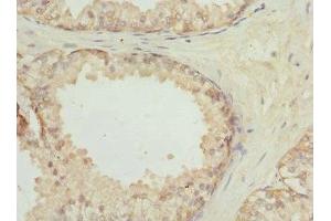Immunohistochemistry of paraffin-embedded human prostate cancer using ABIN7153465 at dilution of 1:100