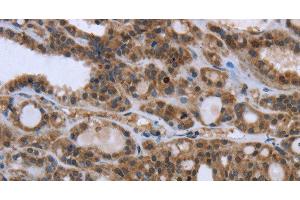 Immunohistochemistry of paraffin-embedded Human thyroid cancer using GGCX Polyclonal Antibody at dilution of 1:50 (GGCX 抗体)
