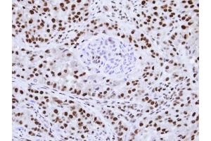 Immunohistochemical staining of paraffin-embedded A549 Xenograft using hnRNP F antibody at a dilution of 1:100 (HNRNPF 抗体)