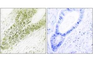 Immunohistochemistry analysis of paraffin-embedded human colon carcinoma tissue, using Ubinuclein Antibody. (Ubinuclein 1 抗体  (AA 161-210))