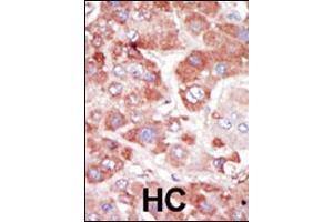 Formalin-fixed and paraffin-embedded human cancer tissue reacted with the primary antibody, which was peroxidase-conjugated to the secondary antibody, followed by AEC staining. (GRK7 抗体  (C-Term))