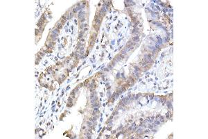 Immunohistochemistry of paraffin-embedded human colon carcinoma using HINT1 Rabbit mAb (ABIN7267663) at dilution of 1:50 (40x lens). (HINT1 抗体)