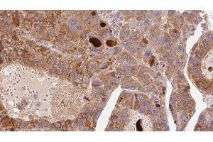 ABIN6276856 at 1/100 staining Human liver cancer tissue by IHC-P. (Fc epsilon RI/FCER1A 抗体  (C-Term))