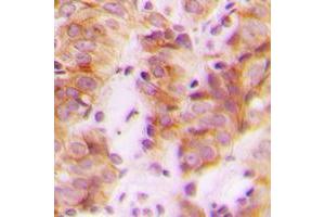 Immunohistochemical analysis of RPL30 staining in human breast cancer formalin fixed paraffin embedded tissue section.