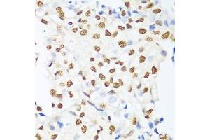 Immunohistochemistry of paraffin-embedded human prostate cancer using HDAC1 antibody. (HDAC1 抗体  (AA 393-482))