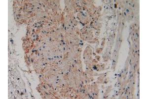 IHC-P analysis of Human Stomach Cancer Tissue, with DAB staining. (PLA2G4A 抗体  (AA 563-749))