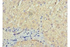 Immunohistochemistry of paraffin-embedded human liver cancer using ABIN7172606 at dilution of 1:100 (SOX14 抗体  (AA 1-137))