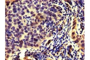IHC image of ABIN7142292 diluted at 1:200 and staining in paraffin-embedded human pancreatic cancer performed on a Leica BondTM system. (HMGCR 抗体  (AA 588-887))