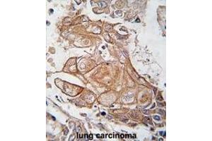 Formalin-fixed and paraffin-embedded human lung carcinoma tissue reacted with Phospho-RGS19-p. (RGS19 抗体  (AA 131-156))