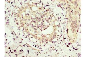 IHC image of ABIN7154254 diluted at 1:300 and staining in paraffin-embedded human breast cancer performed on a Leica BondTM system. (NMT1 抗体  (AA 1-158))