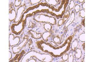 Paraformaldehyde-fixed, paraffin embedded human liver carcinoma, Antigen retrieval by boiling in sodium citrate buffer (pH6) for 15min, Block endogenous peroxidase by 3% hydrogen peroxide for 30 minutes, Blocking buffer (normal serum) at 37°C for 20min, Antibody incubation with Peroxiredoxin 1 (7A1) Monoclonal Antibody  at 1:50 overnight at 4°C, followed by a conjugated secondary and DAB staining. (Peroxiredoxin 1 抗体)