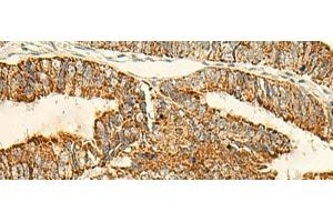 Immunohistochemistry of paraffin-embedded Human colorectal cancer tissue using IFT27 Polyclonal Antibody at dilution of 1:50(x200) (RABL4 抗体)
