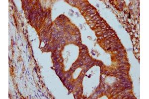 IHC image of ABIN7154052 diluted at 1:500 and staining in paraffin-embedded human colon cancer performed on a Leica BondTM system. (GLRX5 抗体  (AA 32-157))