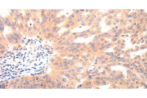 Immunohistochemistry of paraffin-embedded Human ovarian cancer using BGLAP Polyclonal Antibody at dilution of 1:40 (Osteocalcin 抗体)