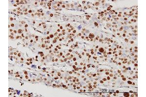 Immunoperoxidase of monoclonal antibody to STK38 on formalin-fixed paraffin-embedded human malignant lymphoma, diffuse large B tissue [antibody concentration 5 ug/ml] (STK38 抗体  (AA 1-465))