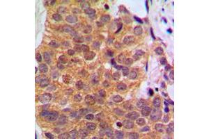 Immunohistochemical analysis of RAR beta staining in human breast cancer formalin fixed paraffin embedded tissue section. (Retinoic Acid Receptor beta 抗体  (C-Term))