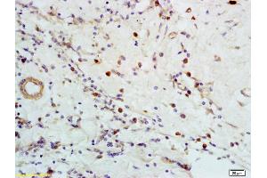 Formalin-fixed and paraffin embedded human breast carcinoma labeled with Anti-CXCR5 Polyclonal Antibody, Unconjugated (ABIN701380) at 1:200 followed by conjugation to the secondary antibody and DAB staining (CXCR5 抗体  (AA 281-372))