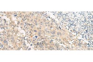 Immunohistochemistry of paraffin-embedded Human cervical cancer tissue using GPR22 Polyclonal Antibody at dilution of 1:50(x200) (GPR22 抗体)