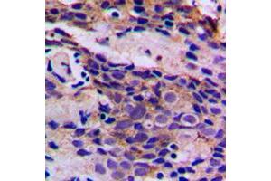Immunohistochemical analysis of CDK5 (pY15) staining in human breast cancer formalin fixed paraffin embedded tissue section. (CDK5 抗体  (N-Term, pTyr15))