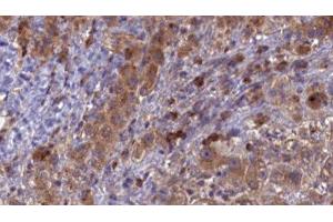 ABIN6276857 at 1/100 staining Human liver cancer tissue by IHC-P. (CD3 epsilon 抗体  (C-Term))