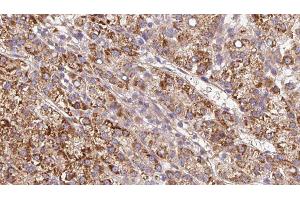 ABIN6279610 at 1/100 staining Human liver cancer tissue by IHC-P. (CHRNB4 抗体  (Internal Region))