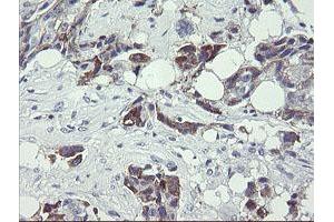 Immunohistochemical staining of paraffin-embedded Adenocarcinoma of Human breast tissue using anti-TDO2 mouse monoclonal antibody. (TDO2 抗体)