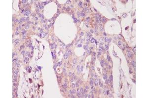 Immunohistochemical analysis of paraffin-embedded human colon, using PKC alpha Antibody. (Recombinant PKC alpha 抗体)