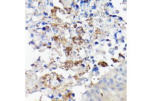 Immunohistochemistry of paraffin-embedded human lung cancer using CD68 Rabbit pAb (ABIN6132070, ABIN6138218, ABIN6138221 and ABIN6217224) at dilution of 1:50 (40x lens). (CD68 抗体  (AA 22-319))