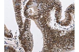 The image on the left is immunohistochemistry of paraffin-embedded Human colon cancer tissue using ABIN7128978(CMTM2 Antibody) at dilution 1/60, on the right is treated with fusion protein. (CMTM2 抗体)