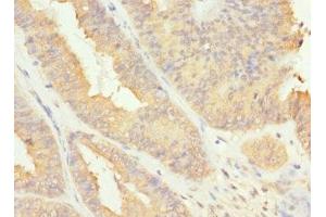 Immunohistochemistry of paraffin-embedded human endometrial cancer using ABIN7167233 at dilution of 1:100 (RAB17 抗体  (AA 1-212))