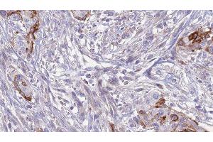 ABIN6277621 at 1/100 staining Human urothelial cancer tissue by IHC-P. (SLC3A1 抗体  (C-Term))