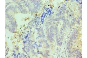 Immunohistochemistry of paraffin-embedded human colon cancer using ABIN7156999 at dilution of 1:100 (IFT57 抗体  (AA 170-429))