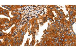 Immunohistochemistry of paraffin-embedded Human ovarian cancer using CAP2 Polyclonal Antibody at dilution of 1:50 (CAP2 抗体)