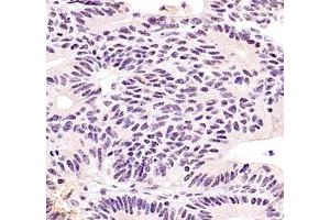 Immunohistochemistry of paraffin embedded human colon cancer using ZKSCAN4 (ABIN7076265) at dilution of 1:400 (400x lens) (ZKSCAN4 抗体)