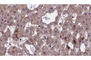 ABIN6277501 at 1/100 staining Human liver cancer tissue by IHC-P. (CHRNB1 抗体  (N-Term))