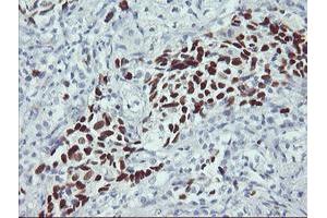 Immunohistochemical staining of paraffin-embedded Carcinoma of Human lung tissue using anti-TP53 mouse monoclonal antibody. (p53 抗体)