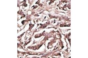 Formalin-fixed and paraffin-embedded human cancer tissue reacted with the primary antibody, which was peroxidase-conjugated to the secondary antibody, followed by DAB staining. (ATG7 抗体  (AA 284-313))