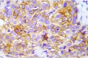 Immunohistochemistry (IHC) analyzes of p-CrkL (Try207) antibody in paraffin-embedded human lung adenocarcinoma tissue. (CrkL 抗体  (pTyr207))