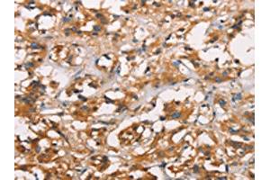 The image on the left is immunohistochemistry of paraffin-embedded Human thyroid cancer tissue using ABIN7189818(ANXA2R Antibody) at dilution 1/25, on the right is treated with synthetic peptide. (Chromosome 5 Open Reading Frame 39 (C5orf39) 抗体)