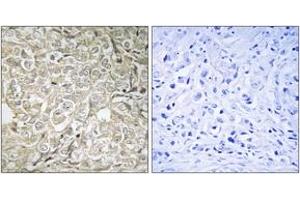 Immunohistochemistry analysis of paraffin-embedded human prostate carcinoma tissue, using RAB37 Antibody. (RAB37 抗体  (AA 170-219))