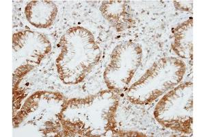 Immunohistochemical analysis of Paraffin-Embedded GASTRIC CA, using AP31129PU-N RGS14 antibody at 1/100 dilution. (RGS14 抗体  (AA 504-516))