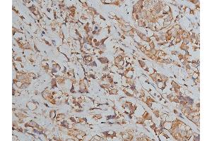 ABIN6267039 at 1/50 staining human breast cancer tissue sections by IHC-P. (Histone 3 抗体)