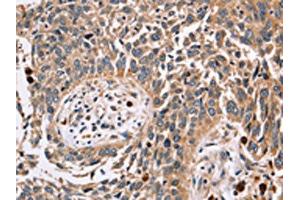 The image on the left is immunohistochemistry of paraffin-embedded Human lung cancer tissue using ABIN7129551(FUCA1 Antibody) at dilution 1/30, on the right is treated with fusion protein. (FUCA1 抗体)