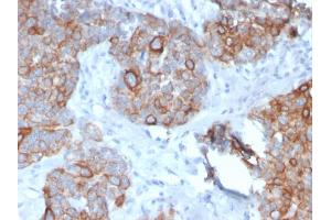 Formalin-fixed, paraffin-embedded human Prostate Carcinoma stained with STAT2 Mouse Monoclonal Antibody (STAT2/2650). (STAT2 抗体)