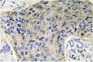 Immunohistochemistry analysis of AQP4 Antibody in Paraffin-Embedded Human lung carcinoma tissue. (Aquaporin 4 抗体)
