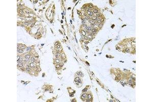Immunohistochemistry of paraffin-embedded Human gastric cancer using SBDS Polyclonal Antibody at dilution of 1:100 (40x lens). (SBDS 抗体)