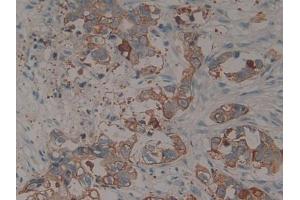 IHC-P analysis of Human Pancreatic cancer Tissue, with DAB staining. (KRT15 抗体  (AA 105-411))