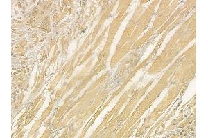 ABIN6265790 and ABIN6276352 at 1/100 staining human tongue carcinoma by IHC-P.