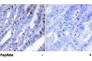 Immunohistochemical analysis of paraffin-embedded human colon carcinoma tissue using PRKAR2B polyclonal antibody . (PRKAR2B 抗体  (Ser113))