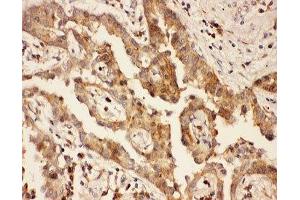 IHC-P: CXCR3 antibody testing of human lung cancer tissue (CXCR3 抗体  (AA 1-368))